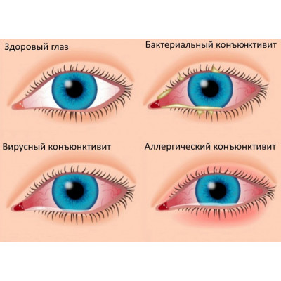 Конъюнктивит: симптомы, лечение и профилактика