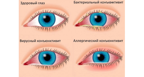 Конъюнктивит: симптомы, лечение и профилактика