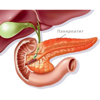Заболевания поджелудочной железы: симптомы, лечение, профилактика