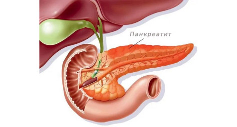 Заболевания поджелудочной железы: симптомы, лечение, профилактика