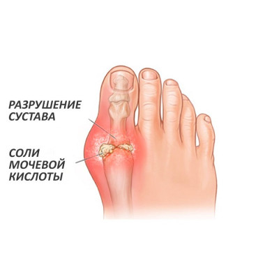 Подагра: симптомы, факторы риска, как предотвратить подагру, профилактика.
