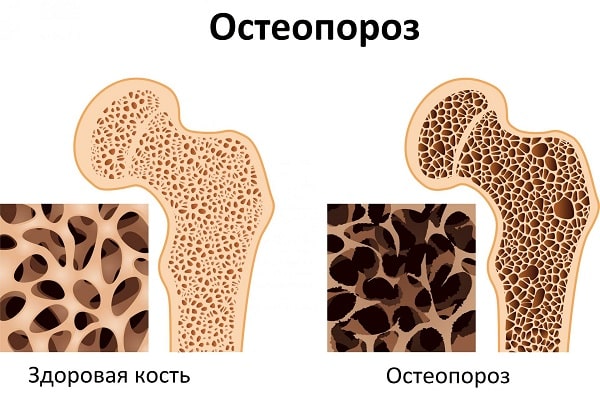 Бон си НСП для лечения остеохондроза и артроза изображение