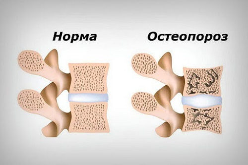 Витамины для организма от остеопороза изображение